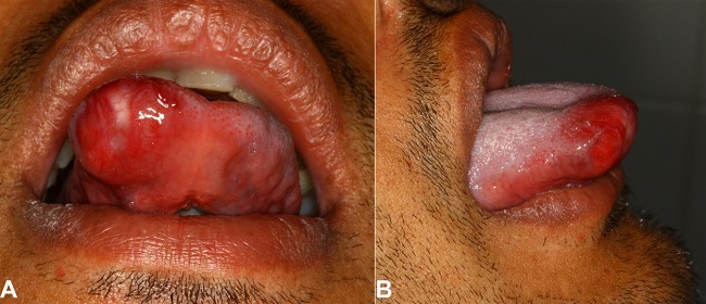 Intraoral examination shows: A - a well-circumscribed mass covered by an erythematous mucosa in the anterior portion of the tongue (Frontal view); B - right lateral view.