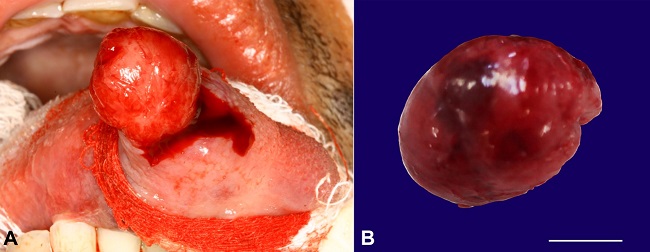 A - Trans-operative aspect of encapsulated lesion on the submucosa; B - size specimen (scale bar = 1 cm).