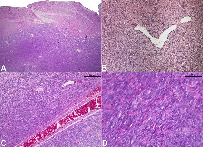 Photomicrographs of the biopsy specimen show: A - a dense proliferation of neoplastic cells partially surrounded by a thick fibrous capsule (H&E, 2.5X); B - Staghorn-like vessels (H&E, 10X); C - branching with evident perivascular hyalinization (H&E, 10X); D - Sheet of the spindle to ovoid cells with indistinct cytoplasmic borders (H&E, 40X).