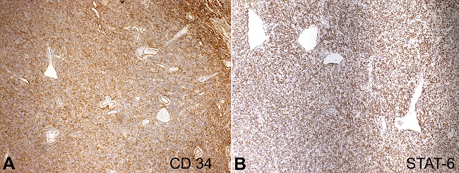 Immunohistochemical panel showing the neoplastic cells with: A - diffuse expression of CD34 (10X); B - STAT-6 (10X).