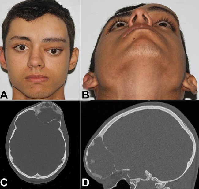 Clinical and imaging aspects. A &ndash; front view showing ocular dystopia; B &ndash; infero-superior view, highlighting the expansive aspect of the lesion; C &ndash; CT axial section, showing a mixed unilocular lesion; D &ndash; CT sagittal section, showing the preservation of the anterior and posterior cortices.