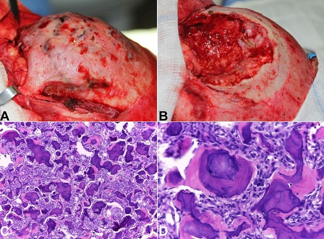 Surgical and histopathological aspects. A &ndash; Coronal surgical access; B &ndash; Surgical site after curettage and peripheral osteotomy; C &ndash; Histopathological examination (HE, 100X) showing a hypercellular stroma and multiple intermingled calcified structures; D &ndash; Histopathological examination (HE, 200X) emphasizing the psammomatoid bodies.