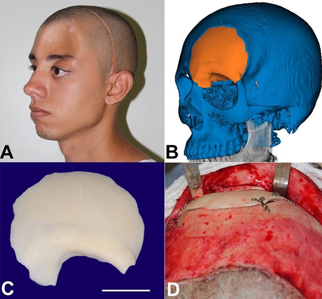 Planning and rehabilitation. A &ndash; Postoperative appearance after the first surgical intervention showing concavity with a noticeable aesthetic defect; B &ndash; Planning guided by CT; C &ndash; Polymethylmethacrylate implant (scale bar = 2,5 cm); D &ndash; Implant fixed with plates and screws from the fixation system1.5.
