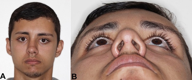 Final postoperative period (06 months). A &ndash; Frontal view with significant improvement in aesthetic appearance, but with slight remaining ocular dystopia; B &ndash; Inferior-superior view.