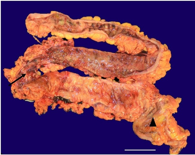 Photomicrography of the ascending, transverse, and descending colon showing multiple ulcers and erosions (arrow) with skip lesions (arrowhead) in a patient with Crohn&rsquo;s disease (scale bar = 3 cm).
