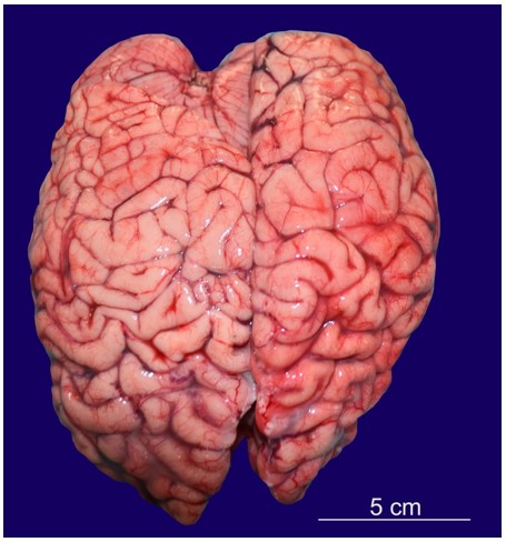 Asymmetrical cerebral hemispheres showing larger right frontal lobe and left occipital lobe.
