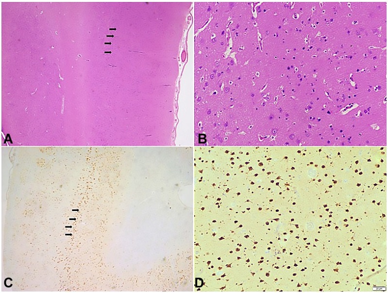 Photomicrography of the Central Nervous System. A - Tangential Disruption of cortical layers marked with black arrows (H&E, 100x); B - Higher magnification of tangential disruption of cortical layers without any identifiable dysmorphic neurons or balloon cells (H&E, 400x); C: NeuN highlights disordered arrangement of cortical layers marked with black arrows (100x); D: Higher magnification of cortical disruption of neurons highlighted by NeuN (400x).