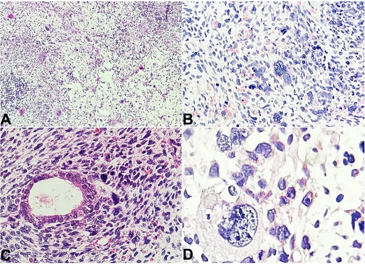 Photomicrographs of the cervical polyp. A - Scanner view shows a stromal tumor composed of marked cytological atypia in the form of nuclear pleomorphism, high N:C ratio, and markedly pleomorphic cells with scant cytoplasm and bizarre nuclei, with the presence of binucleation and fetoid cells with conspicuous nucleoli (H&E; 40x); B - shows the presence of nuclear pleomorphism and atypia with the presence of fetoid/embryonal cells and atypical mitotic figures (H&E; 100x); C - shows stromal tumor cells surrounding an endometrial gland (H&E; 100x); D - shows a fetoid tumor cell with nuclear irregularity, high N:C ratio and presence of multiple conspicuous nucleoli present among surrounding tumor cells (H&E; 400x).