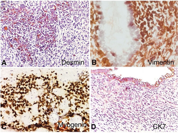 Photomicrographs of the cervical polyp. A - shows immunoreactivity to Desmin (100x); B - Vimentin (100x), and C - Myogenin (100x); D - negative reaction to CK7 (100x).