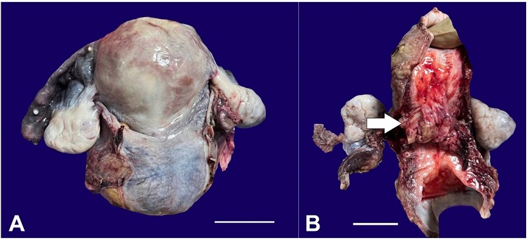 Gross image of the resected uterus after TAH+BSO with the external surface of the uterus and cervix appearing smooth (A) (scale bar= 10 cm); and the cut surface showing a cervical tumor (arrow), extending into the lower uterine segment (B) (scale bar= 10cm).