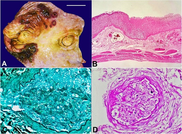 A - Macroscopic view of the stomach with multiple targetoid lesions of varying size, round to oval in shape with elevated margins and necrotic base (scale bar= 5 cm); B - Section from stomach depicting the transition zone between viable and necrotic tissue, left side of the image shows viable gastric tissue with patent submucosal blood vessels, while the right side shows bland necrosis with obliterated blood vessels (H&E, 20x); C and D - Gomori methenamine silver (GMS) and Periodic acid Schiff (PAS) stains highlight the angioinvasive fungal profiles within the submucosal blood vessels (400x). These hyphae are broad, aseptate foldable with right angle branching conforming to the morphology of mucormycosis.