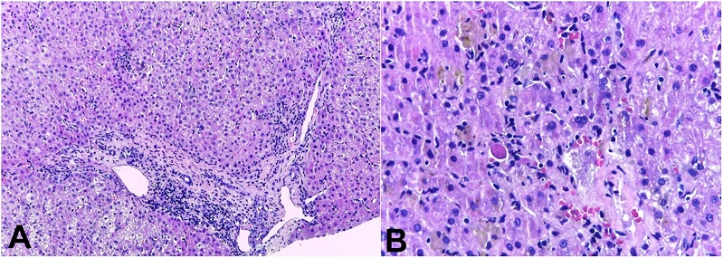 Photomicrographs of the liver biopsy. A - acute/subacute pattern of injury: there is a lymphocyte-predominant portal and lobular inflammation with spotty hepatocellular necrosis without significant ductal aggression (H&E, 10x); B - the &ldquo;cholestatic hepatitis&rdquo; injury with spotty necrosis, and acidophil bodies (H&E, 20x).