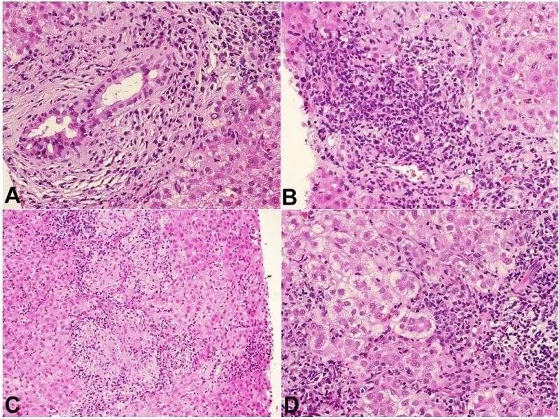 Photomicrograph of the second liver biopsy. A - extensive aggression of the bile duct, with cytoplasmic vacuolization, pyknotic nuclei and a plasma-cell rich infiltrate (H&E, 20x); B - there is a chronic destructive aggression of the bile duct, with numerous plasma cells and interface activity; C - portal and lobular granulomas are also present (H&E, 10x); D - confluent necrosis and pseudorosette hepatocellular regeneration (H&E, 20x).