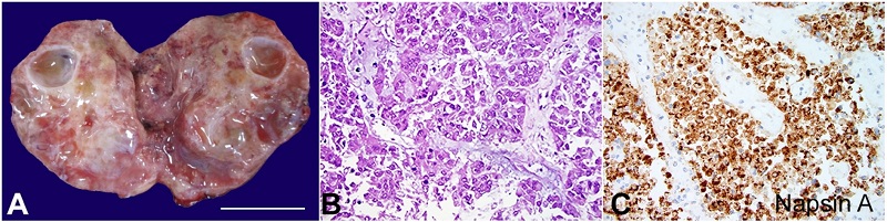 A - cross section of ovarian mass shows a solid gray-white gelatinous surface with few smooth walled cystic spaces and foci of hemorrhage (scale bar= 2 cm); B - the ovarian mass shows a pseudoglandular pattern with pleomorphic polygonal cells. Nuclei are vesicular and nuclear borders are irregular (H&E 400x); C - the tumor is diffusely positive for Napsin A (400x).