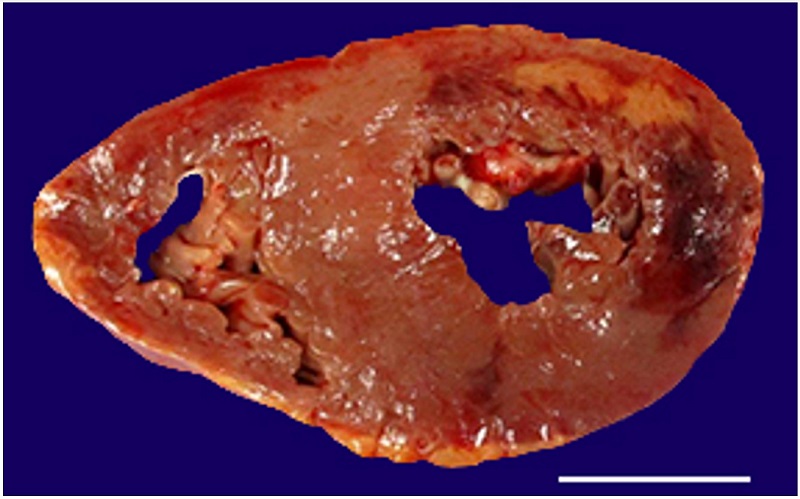Cross section of heart shows a myocardial infarct involving the posterior and free walls of the left ventricle. The affected area is variegated ranging from bright red to yellow indicating various ages of the infarct (scale bar= 3.0 cm).