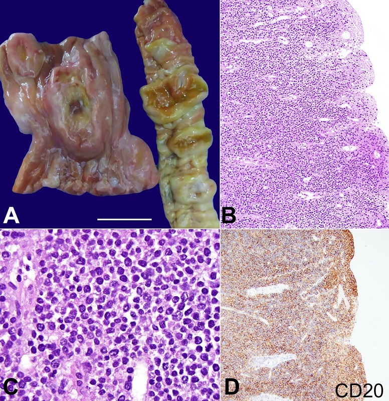 A - gross view of the stomach and small intestine involved by polypoid and ulcerated tumors; B - the wall of the small intestine is diffusely involved by lymphoma (H&E 200X); C - high power in better preserved area shows the lymphoma cells to be pleomorphic, intermediate to large size. (H&E 1000X); D - the tumor is diffusely positive for CD20 (200x).
