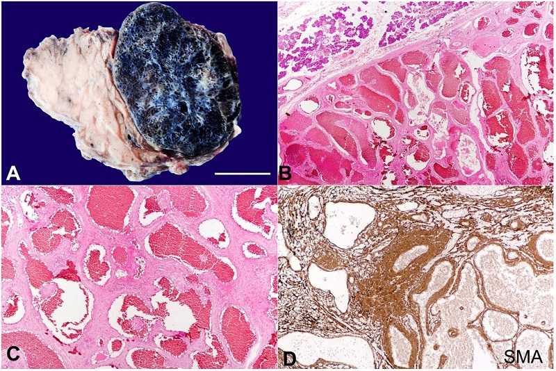A - gross image showing normal salivary gland tissue along with a well-encapsulated tumor with areas of hemorrhage and comprising of numerous cystic spaces (vascular channels) scale bar = 2,5 cm; B - microscopic examination at low magnification showing normal salivary gland parenchyma along with a capsulated tumor comprised of many dilated vascular channels (H&E 100X); C - higher magnification image showing thick and thin walls vascular spaces in between fibro-muscular stroma (H&E, 400X); D - immunohistochemical reaction for smooth muscle actin (SMA) demonstrating smooth muscle bundles and vessel walls (SMA, 400X).