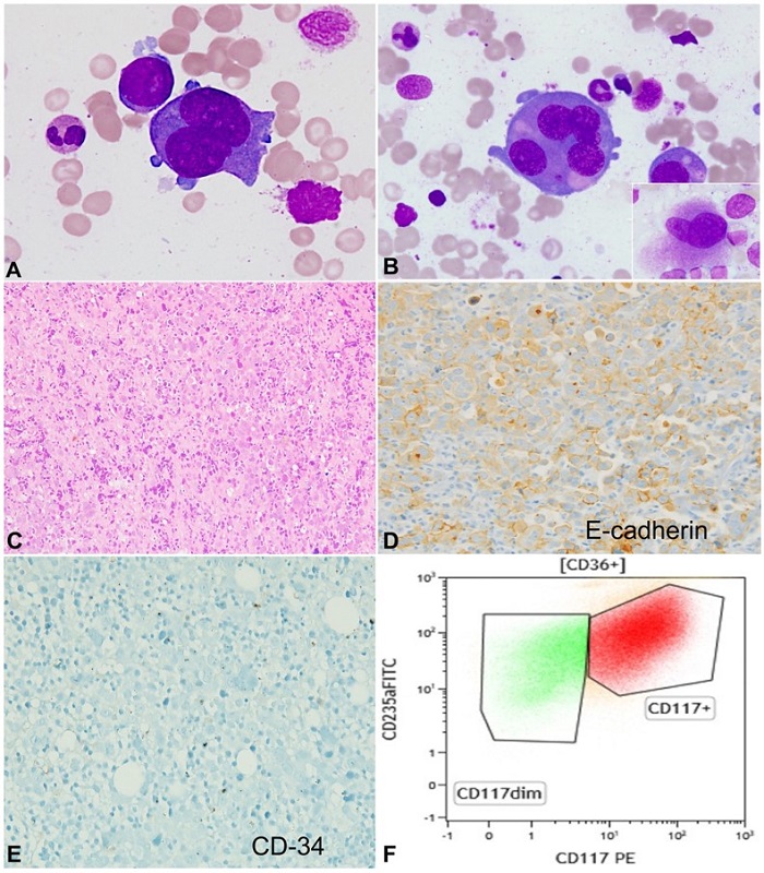 Photomicrograph of the: A - bone marrow aspirate showing large and bizarre looking atypical cells with prominent nucleoli and deep basophilic cytoplasm (Giemsa stain; x400); B - some multinucleated forms are seen (Giemsa stain; x400). Inset showing dysmegakaryopoiesis; C and D - the trephine biopsy shows sheets of immature-appearing cells (C; H&E; x200) which are positive for E-cadherin immunostain (D; x400); E - CD34 is negative (x400); F - flow cytometry plot shows that these atypical cells express CD117 and CD235a.