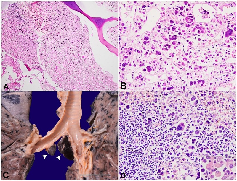 Photomicrograph of: A - the postmortem marrow appeared necrotic in 90-95% area with a few viable pockets of viable cells (H&E; x200); B - these cells depict marked pleomorphism and contain uni- to multi-lobed nuclei, irregular nuclear membrane, nuclear hyperchromasia, inconspicuous nucleoli, and a moderate amount of cytoplasm. Many cells appeared bizarre and multinucleated (H&E; x400); C - on gross, hilar and subcarinal mediastinal lymph nodes (arrowheads) are enlarged and ranges in size from 0.5 to 1.5cm in maximum dimensions (scale bar= 2 cm); D - the subcapsular sinuses are distended by the similar atypical cells (H&E; x200). Inset showing hemophagocytosis.