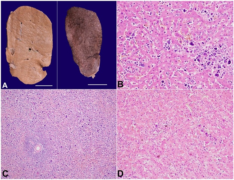 A - gross view of the liver (left) (scale bar= 2 cm) and spleen (right) (scale bar= 2 cm). On slicing, the diffusely enlarged liver and spleen show no definite nodularity; B - photomicrograph of the liver parenchyma showing predominant intra-sinusoidal pattern of infiltration by the atypical cells (H&E; x200); C - the red pulp in spleen shows diffuse expansion due to infiltration (H&E; x100); D - the adrenal gland showing evidence of leukostasis (H&E; x200).