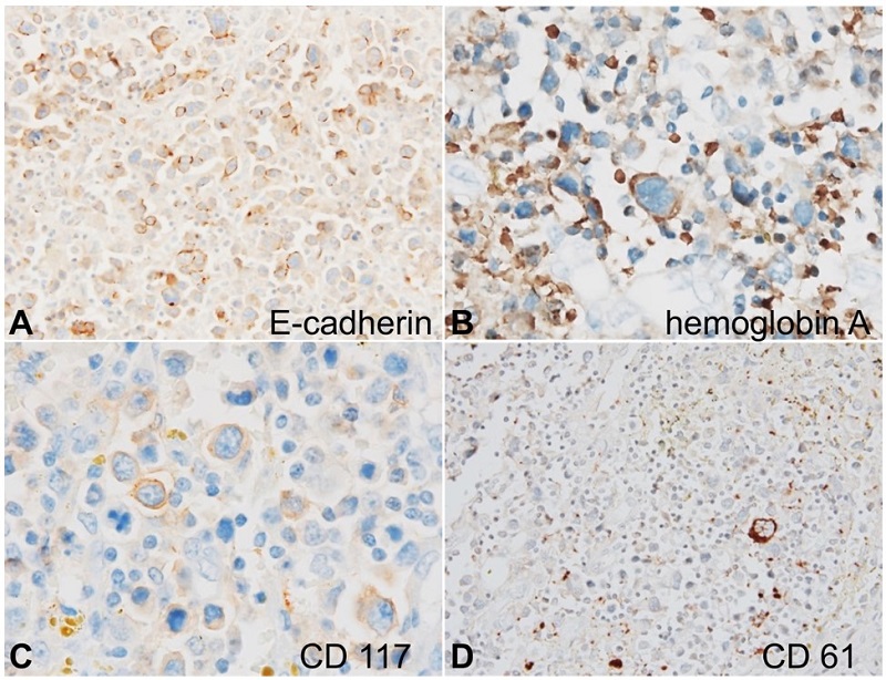 Photomicrograph of the Immunohistochemistry panel of the atypical cells. A - E-cadherin shows membranous positivity (x200); B - hemoglobin A shows membrane-cytoplasmic positivity (x400); C - CD117 shows membrane-cytoplasmic positivity (x400); D - CD61 is negative but highlights megakaryocytes (x200).