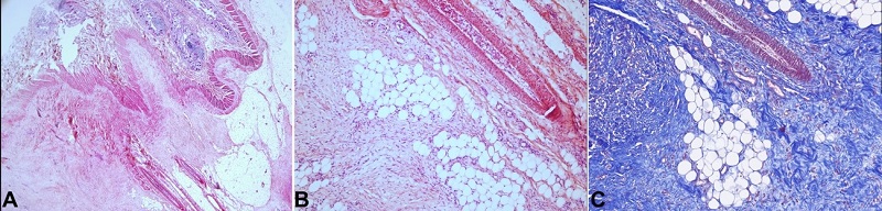 Microphotographs of the junction between the mesentery and bowel wall. A – at low magnification power shows the lesion’s sclerosing nature with the fibroblast substitution of adipose tissue and rectification of vasculature. This lesion contacts the bowel wall in the upper-mid left field (H&E, 20X); B – Lower image at a higher magnification power appreciating an admixture of fibroblasts engorging adipose tissue, with focal areas of fat necrosis and rectified vasculature (H&E, 100X); C – Masson's trichrome staining in the same region as depicted in B. This image highlights the presence of variable-sized collagen bundles, which appear to be increased in number, interspersed, and engorging the surrounding adipose tissue (MT, 100X).