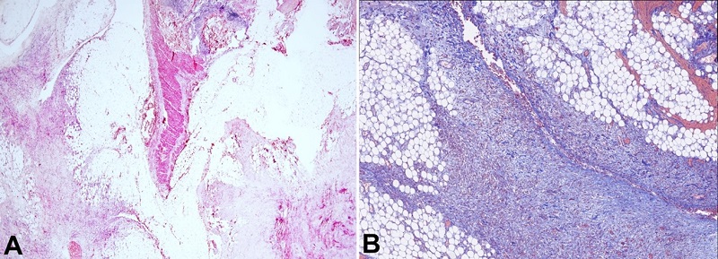 Microphotograph of a 1.5cm mesenteric distant mass that exhibits the same features as the primary lesion but on a smaller scale. Notably, the image showcases the admixture of fibroblasts with adipose tissue in the bottom left and bottom right fields. In the middle of the image, a tangential cut of the bowel wall is visible, with the mucosa positioned on top (H&E, 20X); B – Higher magnification power at the bottom right field of A. Masson's trichrome staining emphasizing the heterogeneous distribution of collagen bundles, varying in size, which exhibit an increased density and are intermingled within the adipose tissue. Additionally, focal areas of hemorrhage can be discerned (MT 40X).