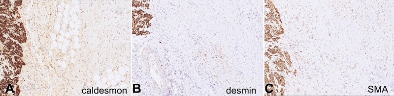 Microphotographs illustrating immunohistochemical staining for caldesmon (A), desmin (B), and smooth muscle actin (SMA) (C). The three images display a positive internal control on the left side, representing the muscularis propria of the bowel wall. In the center of each image, fibroblasts are observed, exhibiting either faint or focal staining positivity for these markers in comparison to the internal control. Multiple stains were employed to verify the positivity and intensity of these immunohistochemical stains (A, B and C – caldesmon, desmin, SMA 100X, respectively).