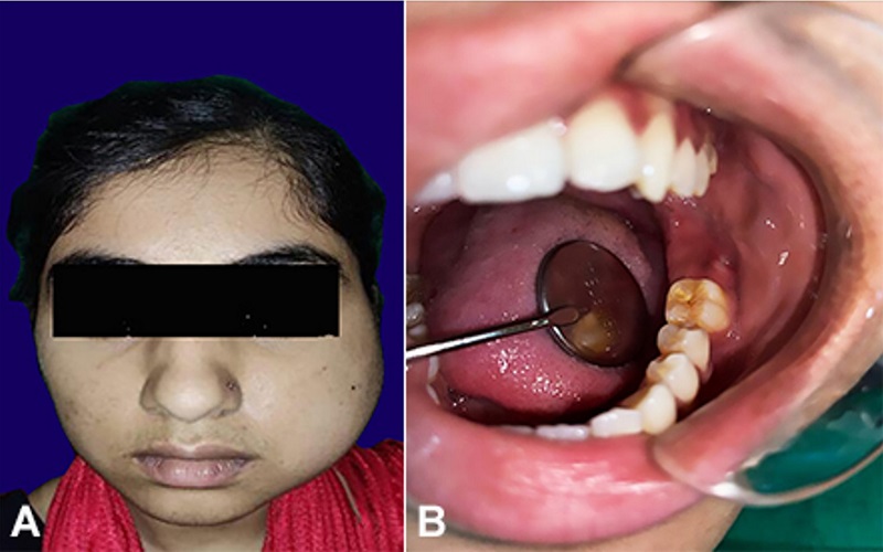 Gross view of: A - facial asymmetry and extraoral swelling evident along the left side of the face; B - draining sinus with pus discharge evident at the left mandibular third molar region.