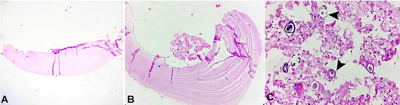 Photomicrograph of the biopsy. A and B - acellular, avascular, eosinophilic lamellated tissue suggestive of chitin (H&E, 4&times; and 10&times;, respectively); C - protoscolices (arrowheads) in the germinal membrane (H&E, 40&times;).