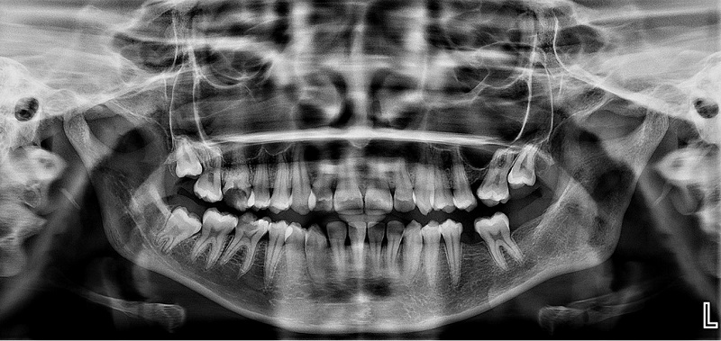 1-year follow-up with postoperative Orthopantamogram reveals a healing lesion with well-defined bony trabeculae formation.