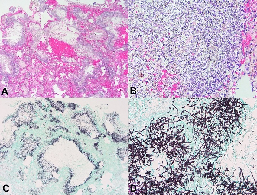 Photomicrographs of the right lung, upper lobe. A - Loss of normal alveolar architecture with the formation of cavitary areas, associated with inflammation, focal hyaline membrane formation, and intra-alveolar hemorrhage (40x, H&E); B - Abundant budding yeasts and invasive pseudohyphae are present in the cavitary areas (400x, H&E); C - GMS stain highlighting areas of fungal infiltration throughout the tissue (40x); D - Pseudohyphae and budding yeasts, morphologically consistent with Candida, are nicely highlighted (400x, GMS).