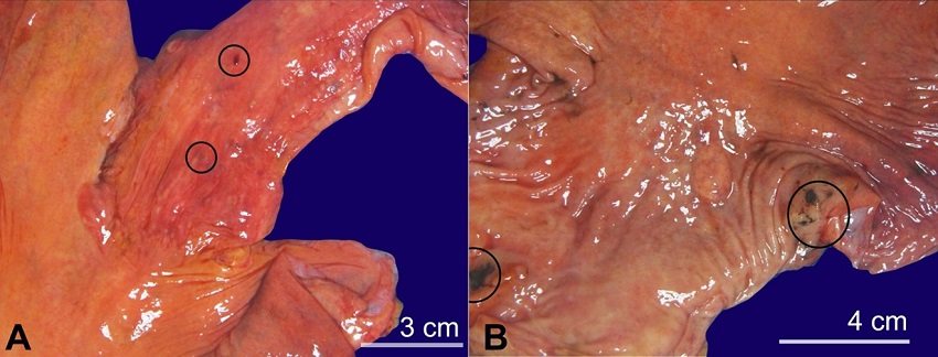 Gross images of the esophagus and stomach. A - Distal esophagus with focal areas of hemorrhage and ulceration; B - Stomach with focal areas of hyperemia and erosion.