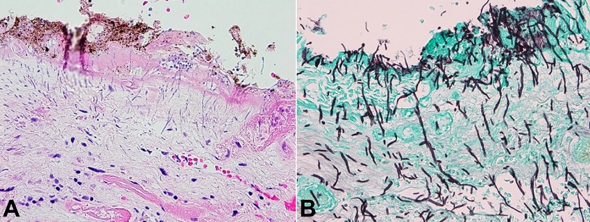 Photomicrographs of the esophagus. A - Area of ulceration, with fibrin and hemosiderin, showing budding yeasts and pseudohyphae infiltrating into the tissue (H&E, 400x); B - GMS stain highlights fungal forms with budding yeast and pseudohyphae invading the mucosa in the area of ulceration (400x).