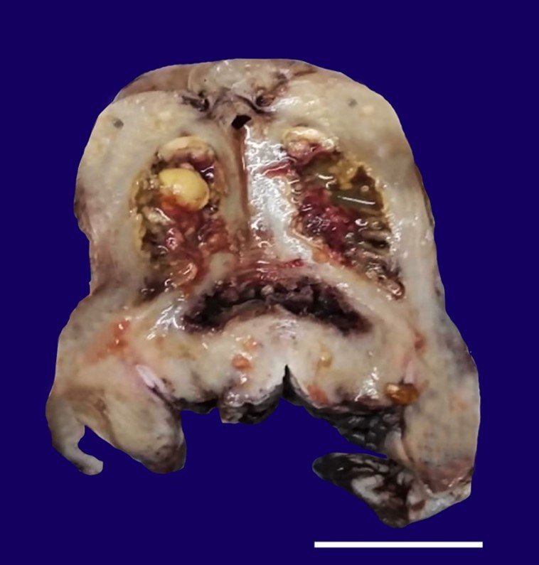 Gross view of the surgical specimen’s cut surface showing the irregular endometrium lined by yellowish friable material. The endometrial cavity shows the presence of yellow-colored stones (scale bar= 4,5 cm).