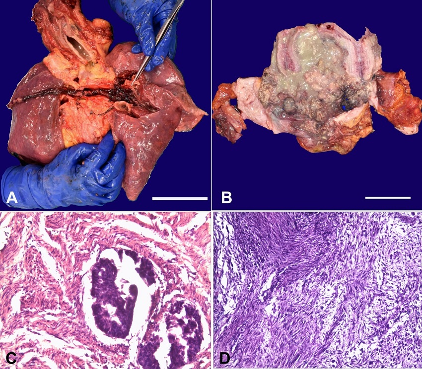 Macroscopic view of lungs showing red-brownish clots in the pulmonary artery trunk extending along the intraparenchymal branches (scale bar= 8 cm); B - Macroscopic view of the uterus after dissection with a vegetative neoformation almost occluding its lumen, in association with abundant yellow-green-blackish material of pasty consistency (scale bar= 7 cm); C - Photomicrograph of the endometrial tumor with remnants of neoplastic glandular epithelial component and of residual glandular pseudo-lumen with multi-layered epithelium and cellular atypia (H&E, 200x); D - Photomicrograph of the endometrial tumor with sarcomatous component partly with fused cellularity, partly in the form of compact bundles with marked nuclear atypia and partly with a myxoid-like structure with foci arranged in bundles associated with a scattered cell neoplastic component (H&E; 100x).