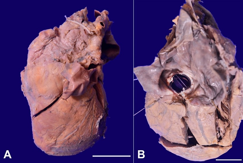 Gross view of: A &ndash; The heart is markedly enlarged and widely oblong weighing 700 g (scale bar= 4cm); B &ndash; Left atrium is markedly dilated with a hinged prosthetic valve with no thrombus or ring abscess formation (scale bar= 3cm).