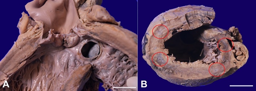 Gross view of: A &ndash; Aortic valves are markedly thickened with commissural fusion, and it shows residual vegetation in the ventricular surface of the left cusp and involving commissure (scale bar=2 cm); B &ndash; Cut surface of the heart after apical slice showing multifocal blackish discolouration involving anterolateral, inferior and posterior wall of the left ventricle (scale bar= 2 cm).