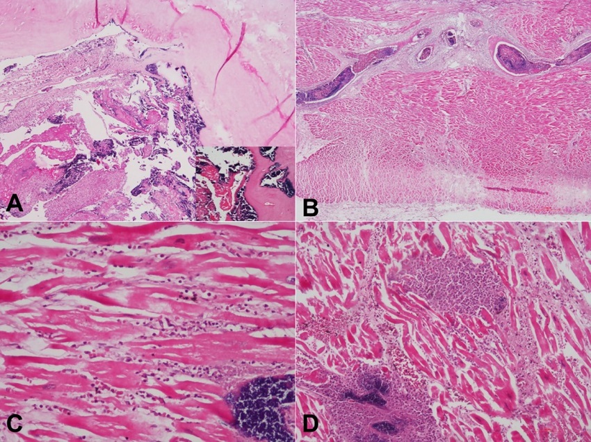 Photomicrographs of the heart. A &ndash; Microscopy of the aortic valve showing vegetation composed of fibrin, neutrophils-rich inflammation, and numerous bacterial colonies (Inset: Gram-positive cocci on gram stain) (H&E, 40X); B &ndash; One of the intramyocardial arteries showing Septic thrombo-emboli with near complete occlusion of lumina (H&E, 40X); C &ndash; Early infarct changes such as edema, neutrophil infiltration and extravasation of RBCs are seen in the surrounding myocardium (H&E, 200X); D &ndash; Micro abscesses around the intramyocardial vessels with seeding of bacterial colonies (H&E, 200X).