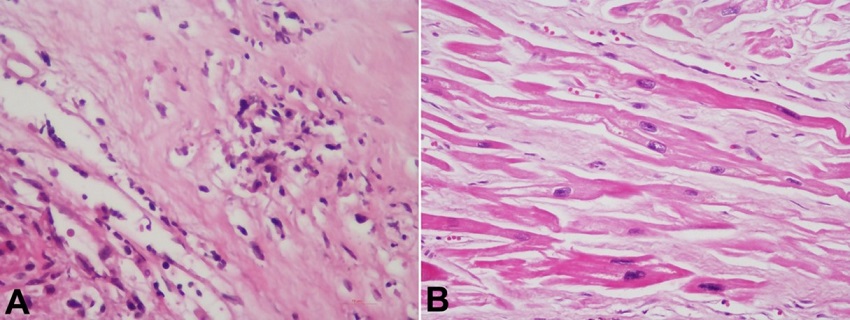 Photomicrograph of the: A &ndash; Aortic valve cusps are showing characteristic Aschoff&rsquo;s nodules with caterpillar cells (H&E, 200X); B &ndash; Myocardium showing remodeling changes with enlarged myocytes containing boxcar-like nuclei and interstitial fibrosis (H&E, 200x).