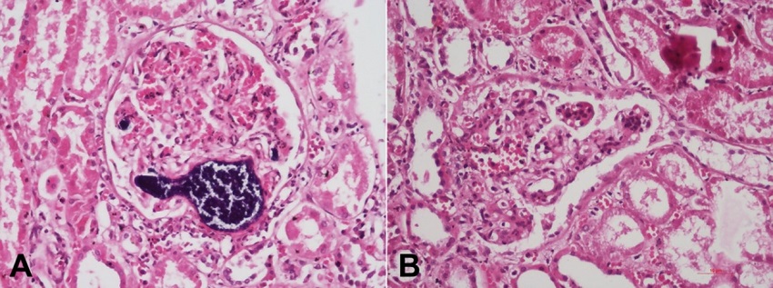Photomicrograph of the kidney: A &ndash; shows septic thrombo-emboli clogging the glomerular capillaries and arterioles (H&E, 200x); B &ndash; Few glomeruli also depict segmental mesangial and endocapillary hypercellularity (H&E, 200x).