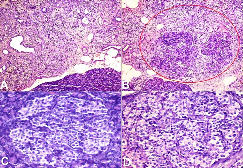 Photomicrographs of the pancreas. A and B - Diffuse proliferation of variably sized islet cells arranged in lobules and forming tubule-insular complex (red circle magnification); C and D - Enlarged Islet cells showing irregular nuclear contour, mildly enlarged nuclei with clear cytoplasm (H&E x400).