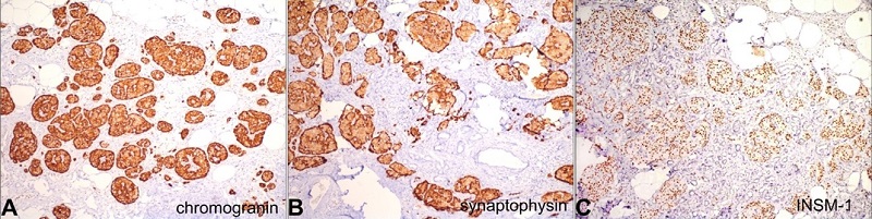 Photomicrographs of the pancreas. Positive immunohistochemical reactions for A &nbsp;- Chromogranin; B - Synaptophysin, C - ISNM-1.