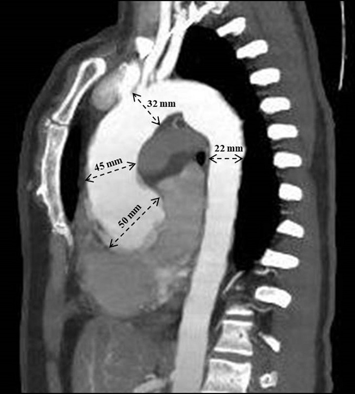 Contrast-enhanced chest CT angiography showing dilatation of the aortic root with a diameter greater than 50 mm in the ascending segment, the ascending segment 45 mm, the aortic arch 32 mm and the descending segment 22 mm.