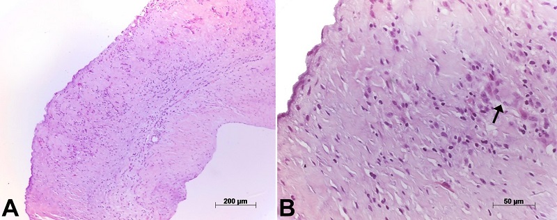 Photomicrographs of an aortic leaflet. In the panel A - with diffuse thickening and chronic inflammatory infiltrate; in the panel B - the arrows point to a Langerhans-type giant cell within the inflammatory infiltrate. Hematoxylin-eosin staining, objective magnifications 10x and 40x, respectively.