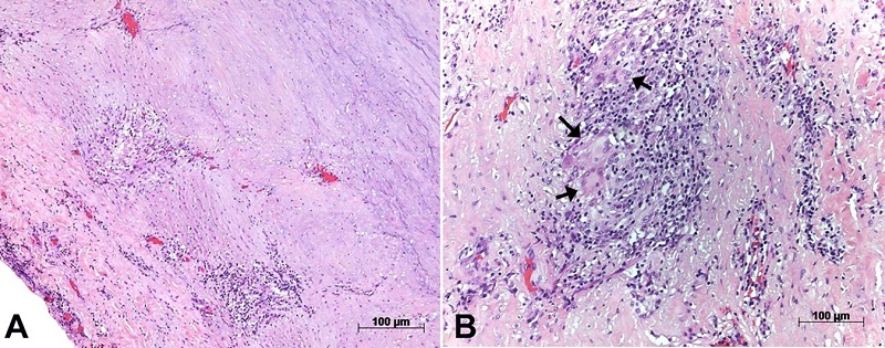 Photomicrographs of the aortic wall showing in panel A - the diffuse involvement of the layers by chronic inflammatory infiltrate; in panel B - a close-up view shows a giant cell within the inflammatory infiltrate. Hematoxylin-eosin staining, objective magnifications 5x and 40x respectively.