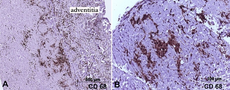 Photomicrographs of the aortic and valvar tissue submitted to immunohistochemical reactions for macrophages (CD68 antigen). In A - the positive cells are concentrated in the external half of the aortic wall, near the adventitia; Panel B - depicts positive macrophages in one aortic leaflet. Objective magnifications are respectively A - 5x; and B - 20x. Mouse monoclonal antibody CD68 (clone KP1), counter-staining with Harry&rsquo;s Hematoxylin.