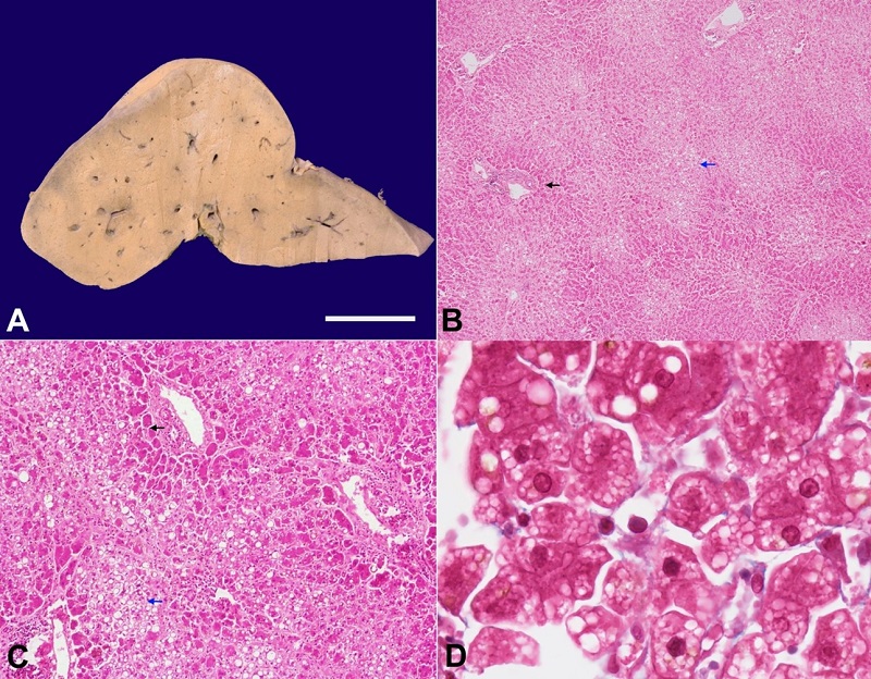 A - gross photograph of the liver showing a homogeneous yellow cut surface; B and C - the microphotograph showing paler zone 2 and zone 3 (blue arrow) and more eosinophilic zone 1 (black arrow) (B - H&E, x40; C - H&E, x200); D - the centrizonal hepatocytes are studded with microvesicles of fat, giving them a foamy appearance (Masson Trichrome, x1000).