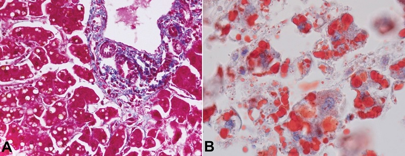 A - the periportal hepatocytes had eosinophilic cytoplasm with scattered macrovesicular steatosis (Masson Trichrome, x400); B - the presence of fat within the microvesicles is highlighted by the Oil-red-O stain (x400).