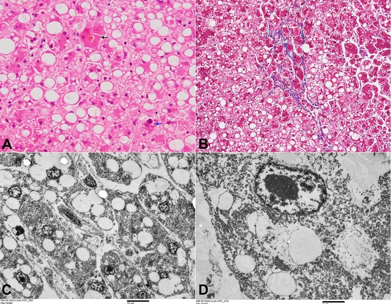 A - microphotograph showing occasional intracanalicular bile plug in the centrizonal area (black arrow) and occasional Mallory Denk Bodies (blue arrow) (H&E, x400); B - occasional focus of perivenular/pericellular fibrosis (Masson Trichrome, x200); C - transmission electron microscopy showing intrahepatocytic microvesicular steatosis (uranyl acetate and lead citrate - scale bar attached); D - transmission electron microscopy showing loss of subcellular structures (uranyl acetate and lead citrate - scale bar attached).